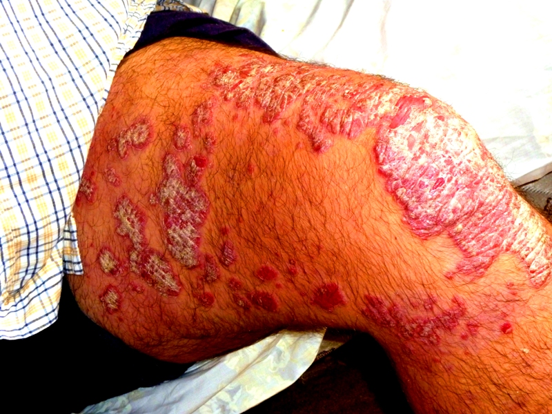 Stelara Clinical Trials Adverse Event, FDA, Psorisis,  Psoriatic athritis, Johnson & Johnson, Janssen Pharmaceuticas, Clinical Trials, Biologic, Failure, Drug Study, Drug Induced Psoriasis, Toxic, Stelara Causes Psoriasis, Stelara Causes Severe Psoriasis, US Senate, Feinstein, Adverse Effects